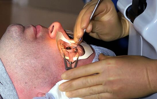 Trumparegystės skleroplastika regėjimui stabilizuoti