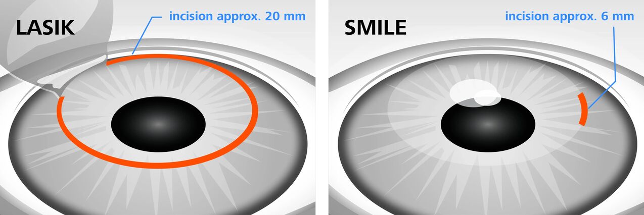 Lazerinės regos korekcijos metodų LASIK ir SMILE palyginimas